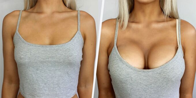 πριν και μετά από πλαστική επέμβαση για αυξητική στήθους