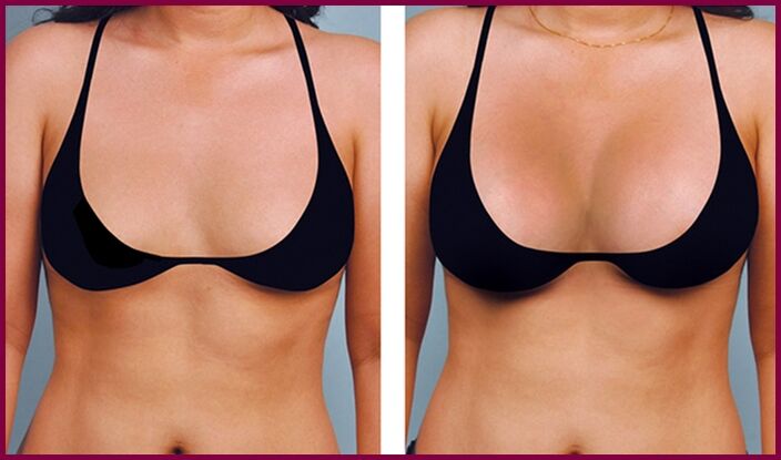 πριν και μετά την αυξητική στήθους με λίπος