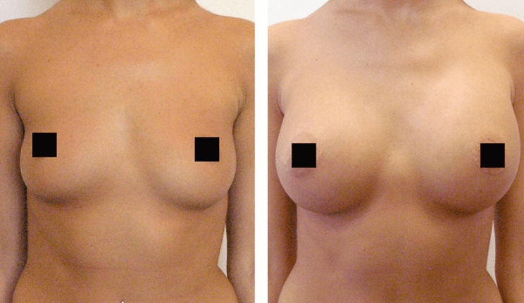 στήθους πριν και μετά την αύξηση με υαλουρονικό οξύ