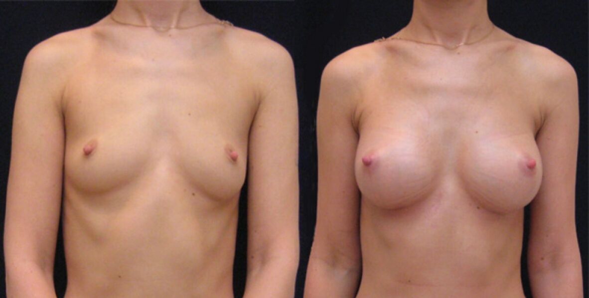 μαστού πριν και μετά την ενδοσκοπική αυξητική