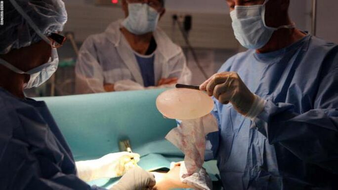 Χαρακτηριστικά της Mammoplasty