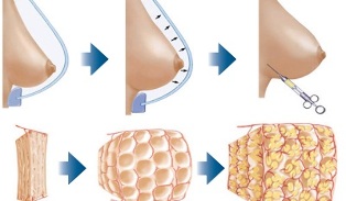 πώς γίνεται η διαδικασία αύξησης του μαστού με λίπος