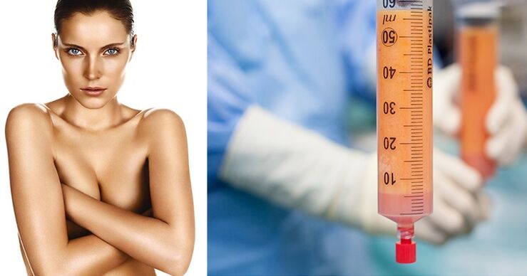lipofilling ως μέθοδος μεγέθυνσης του μαστού